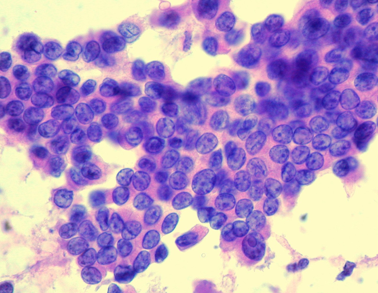 Papillary carcinoma of the thyroid