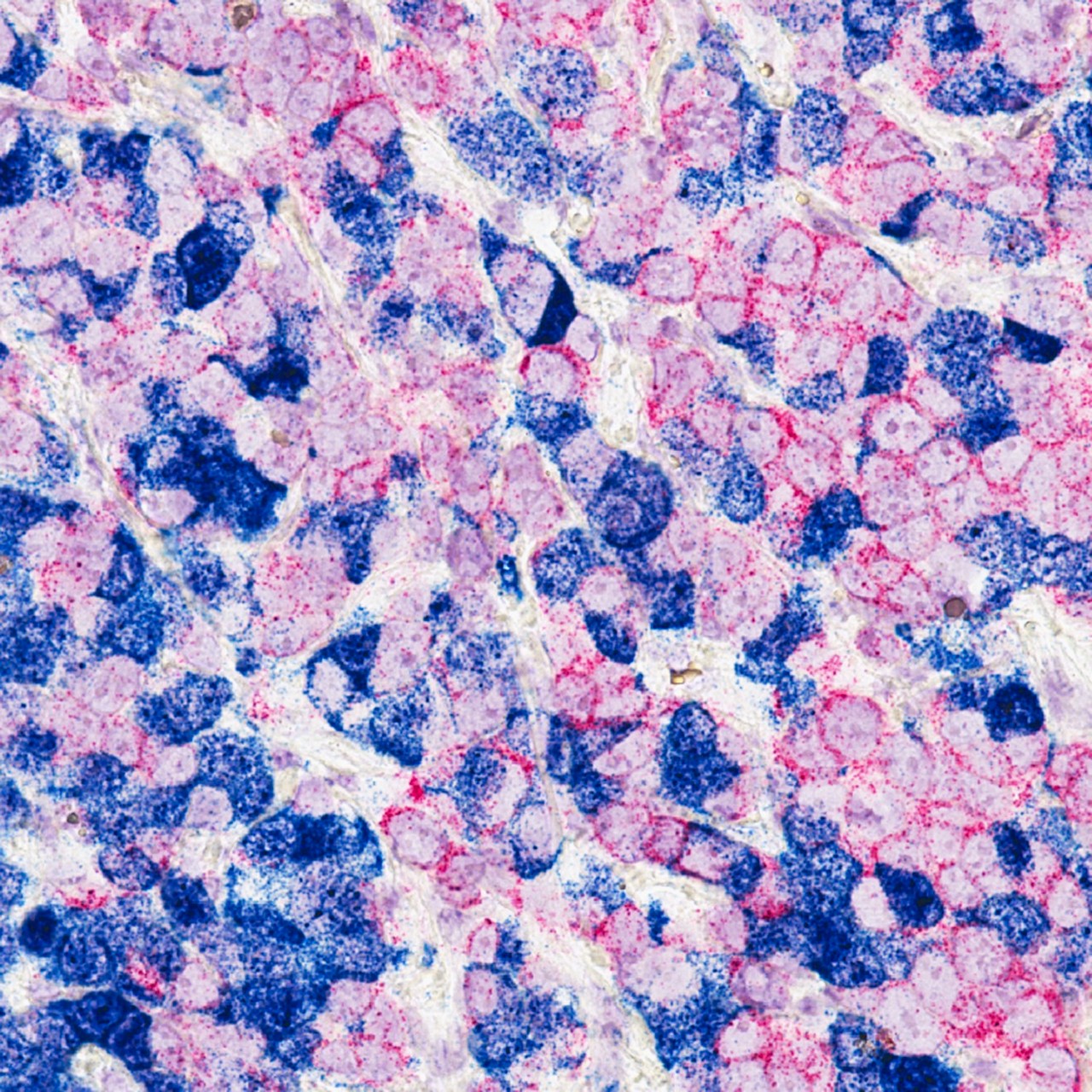 Breast cancer cells