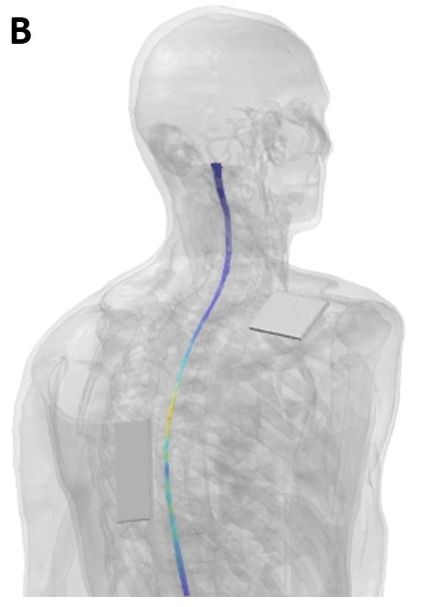 A diagram of a person with blue highlighting the current reaching from the middle of the back to the neck the 