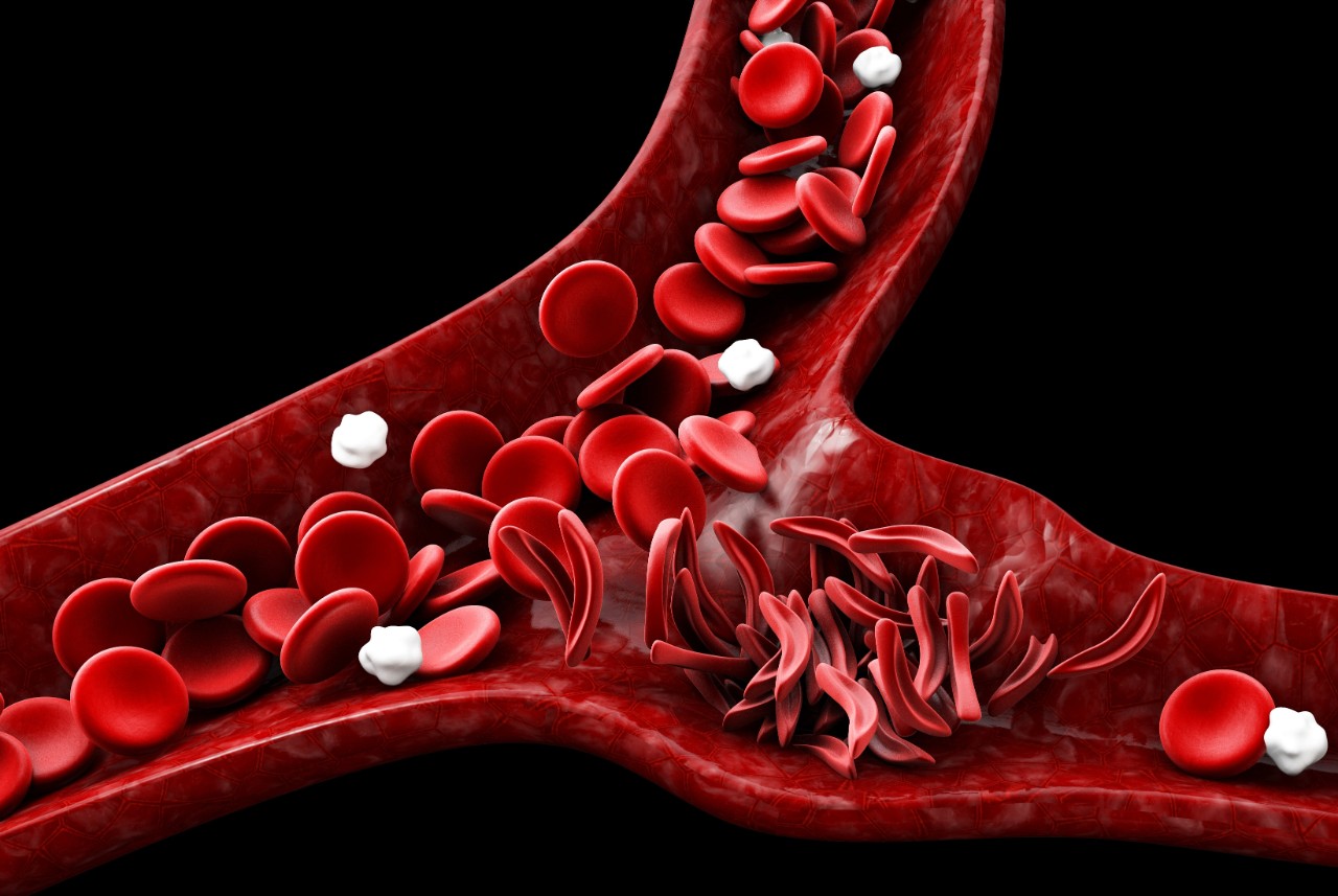 Sickle cell anemia, 3D illustration showing blood vessel with normal and deformed crescent