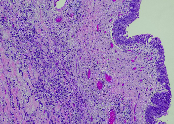 Urothelial carcinoma cells stained purple