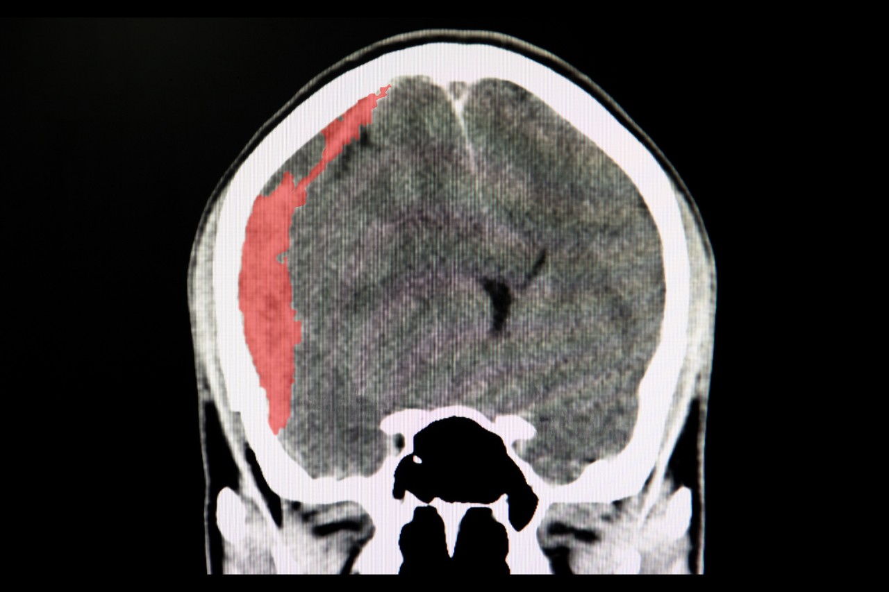 A CT scan of a person's head displaying a subdural hematoma