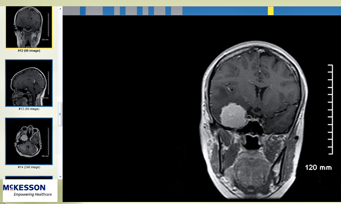 A black and white MRI of a golf-ball sized meningioma brain tumor on right with three small images of the same tumor along the left.