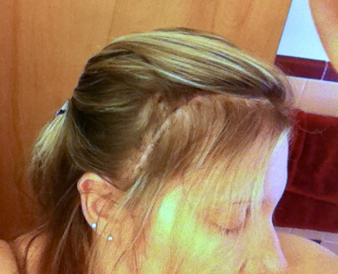 Close-up of the right side of a woman's head revealing a surgery scare hidden inside her hair.