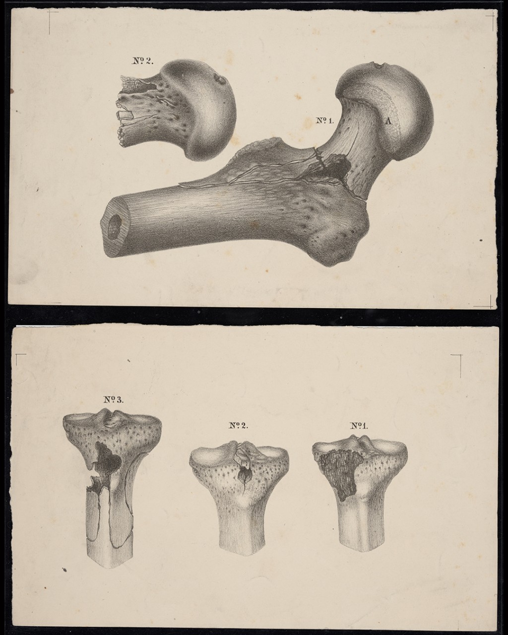 Greyscale drawing of entry and exit wounds of a thigh bone near the hip joint.