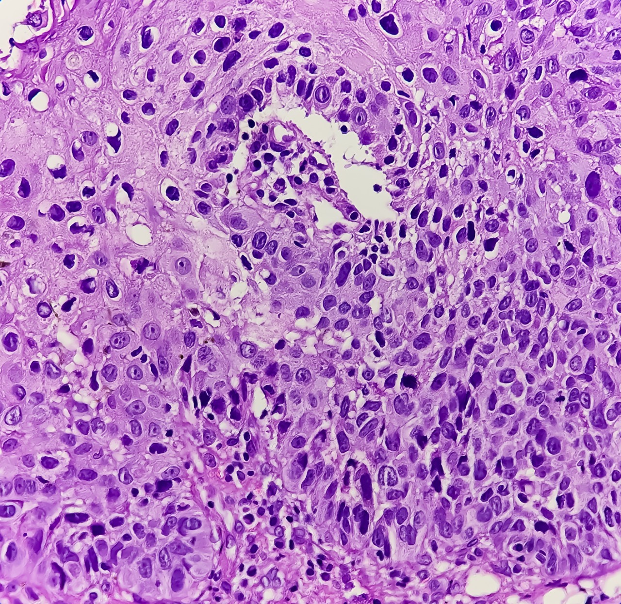 Oropharyngeal cancer cells stained purple