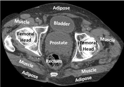  A scanned image of a patient's pelvis. Photo/Range Assure.