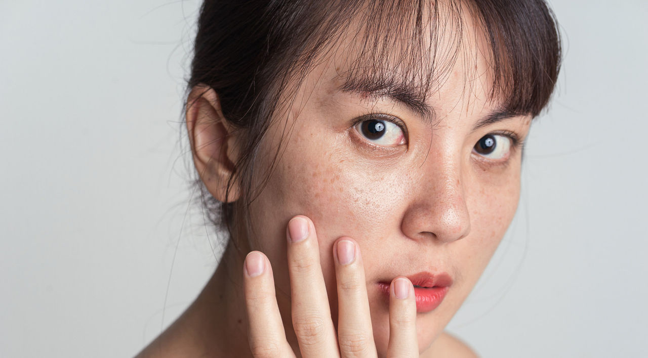 A woman puts her hand up to her freckled face.