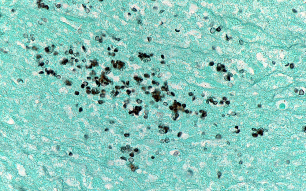 The Bullock Fund will further UCÂ s study of infectious diseases, including how the soil-based fungus histoplasma capsulatum can cause chronic pulmonary diseases.