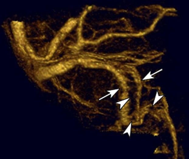 This image from a high detail contrast-enhanced MR venogram shows areas of restored blood flow (arrows) and areas of persistent blood clot (arrowheads).