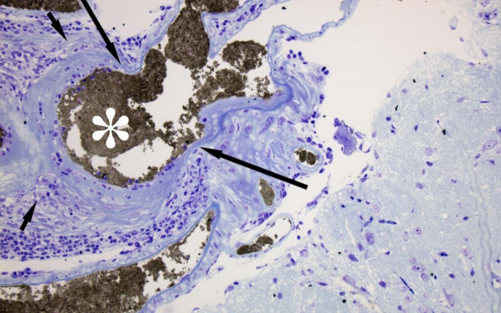 The asterisk in this photo indicates signs of intracranial aneurysm in a preclinical subject.
