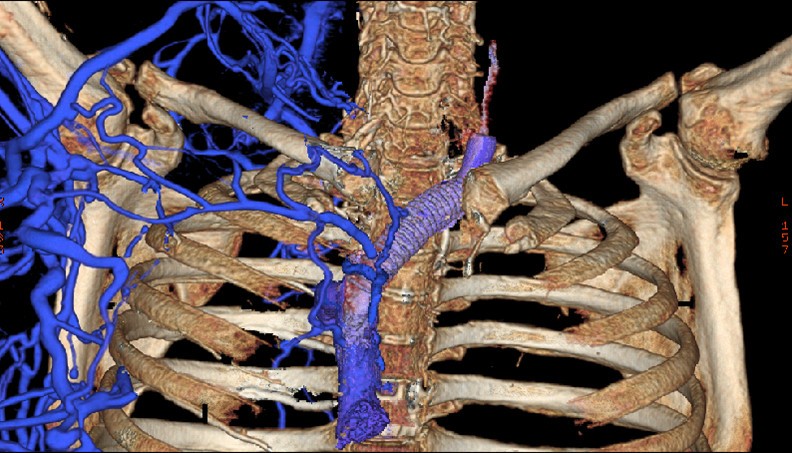 Multi-detector computed tomography scans can be used to more precisely image veins in the chest. 