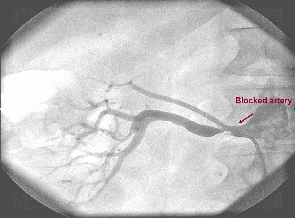 Massoud Leesar, MD, uses ultrasound imaging and a pressure wire to determine the severity of blocked arteries in the heart and kidneys.
