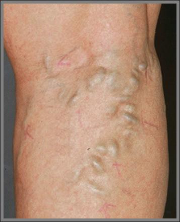 Varicose veins occur when the valves in the veins fail to work properly and allow blood to build up.