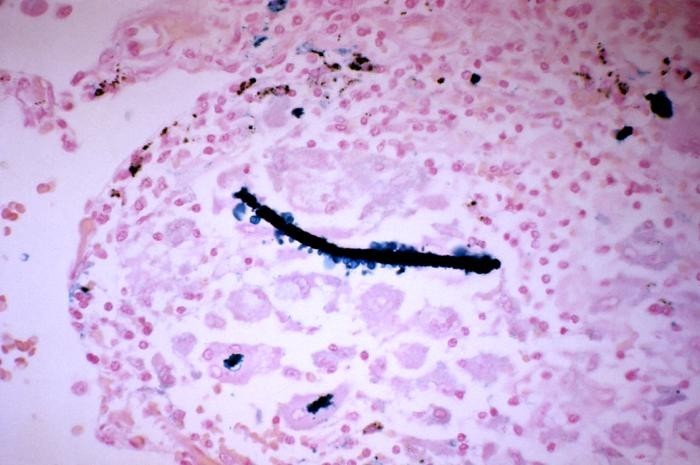 This is an example of how asbestos and asbestos-like mineral fibers lodge in lung tissue.