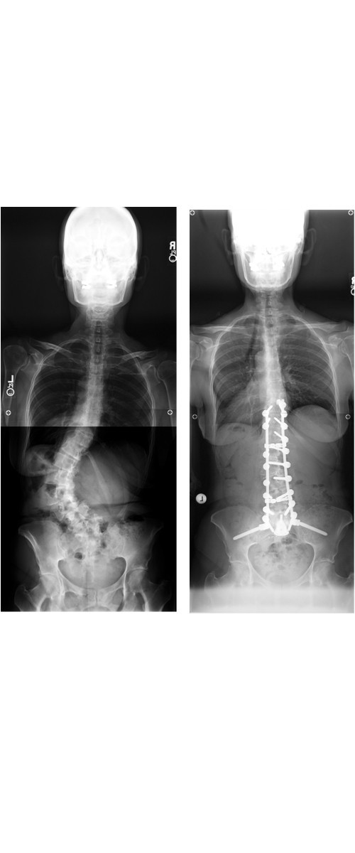 Severe scoliosis before surgery (left) and after.