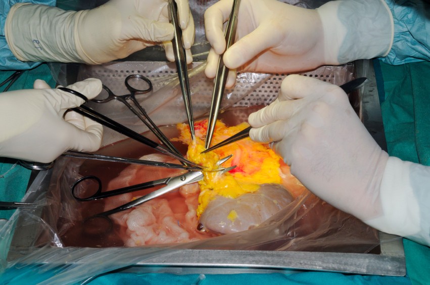 New research shows that altruistic kidney donors can set off chain reactions that make transplants possible for many needy recipients.