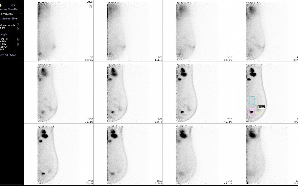 Postitron Emission Mammography (PEM).