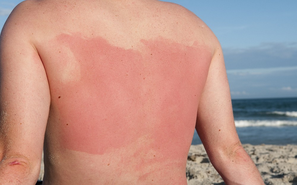 Sunburn