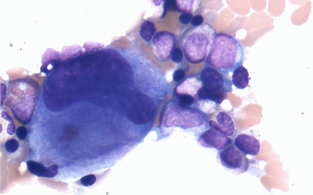 Steve Woodle, MD, Jason Everly, PharmD, and colleagues have found that a cancer drug may help prevent transplanted organ rejection.