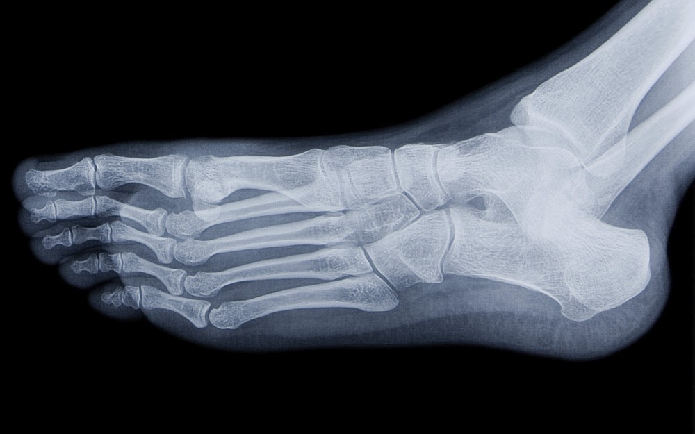 Stress Fractures Are More Common in the Lower Extremities