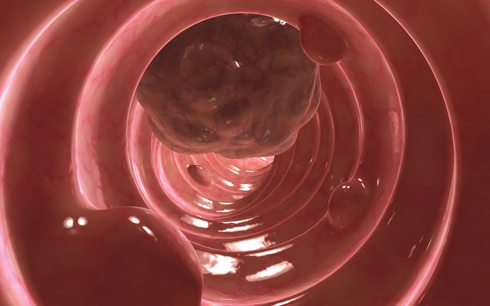 Image of a tumor and polyps in the colon.