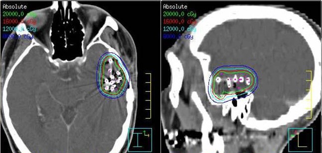TRANSLATIONAL RESEARCH: A new research program, launched in March 2011, is aimed at understanding the biological mechanisms of cancerÂ s spread to the brain and developing more effective ways to treat the condition. More than 170,000 people are diagnosed annually with a secondary cancer that has spread to the brain. 