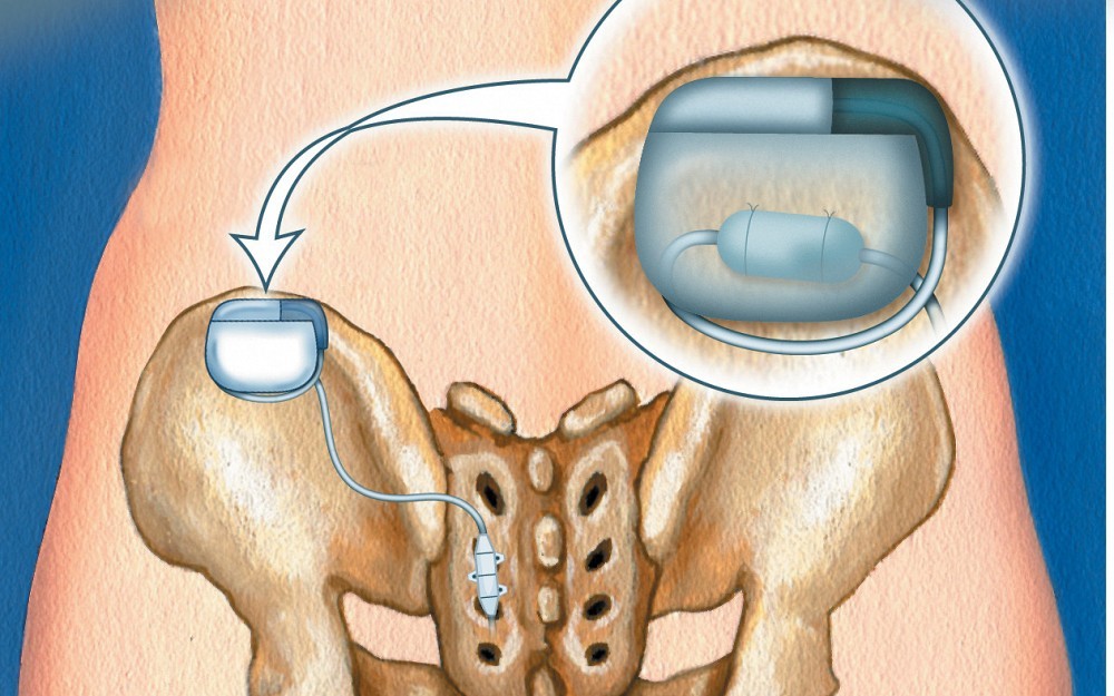 Medical illustration of Interstim device placement 
