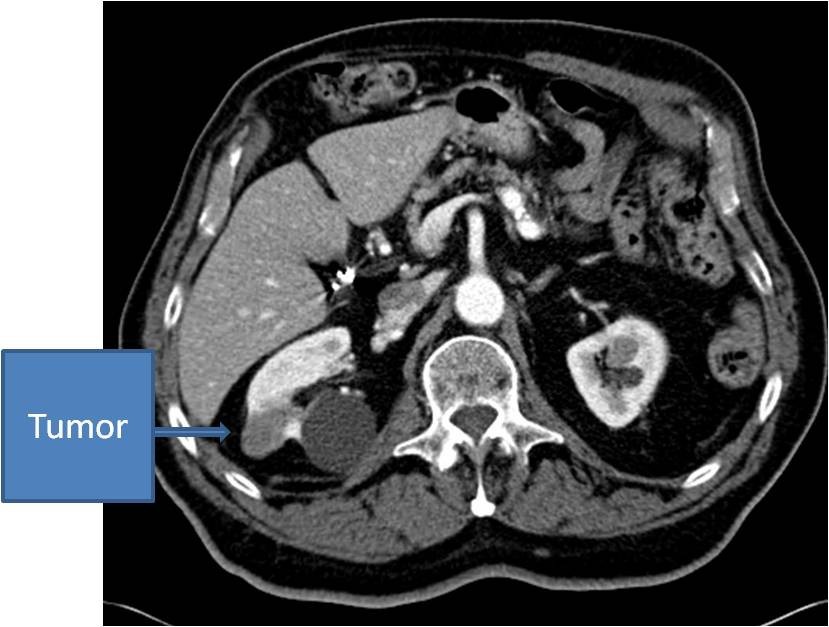 CT scan of a small renal tumor, prior to cryoablation 