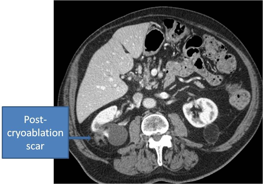 A small renal tumor three months after cryoablation