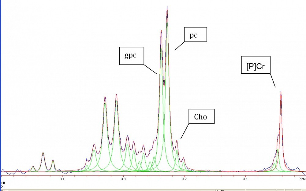 An example of the breast spectroscopy data that will be used to study choline metabolic ratios as markers of human breast cancers. 