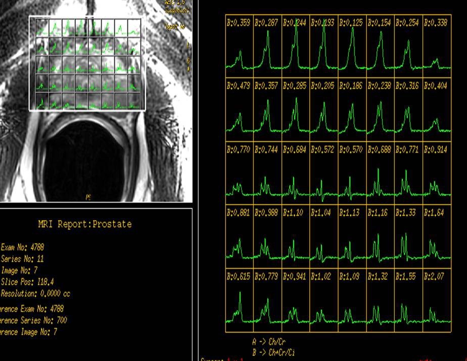 Prostate MRI with spectroscopy