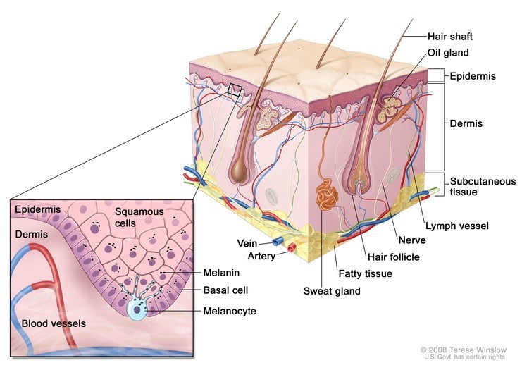 Anatomic illustration of melanoma.