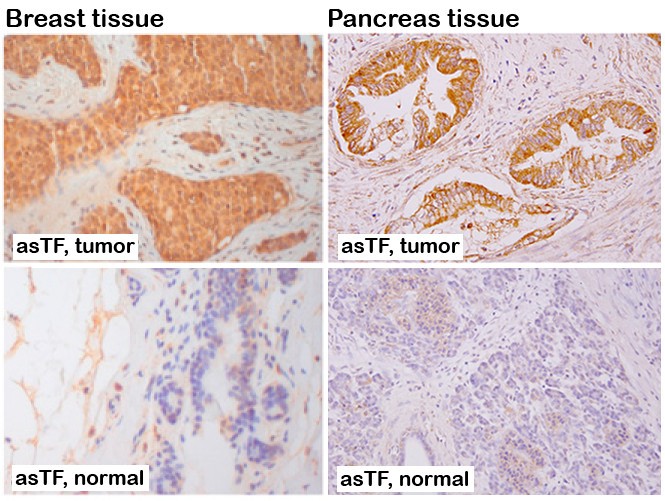 Tumor versus normal asTF in the pancreas and breast