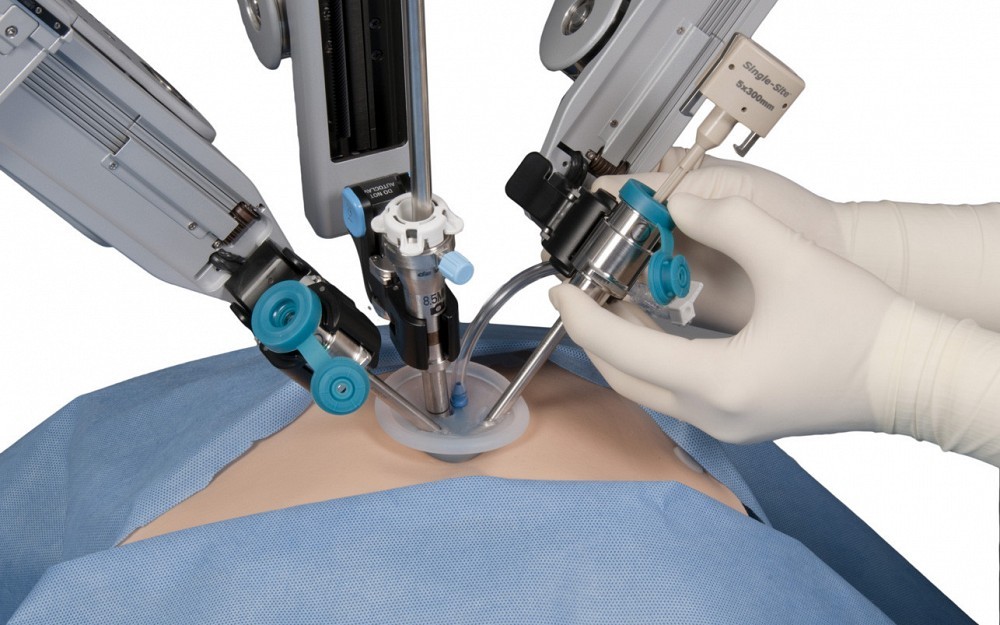 single-site robotic hysterectomy