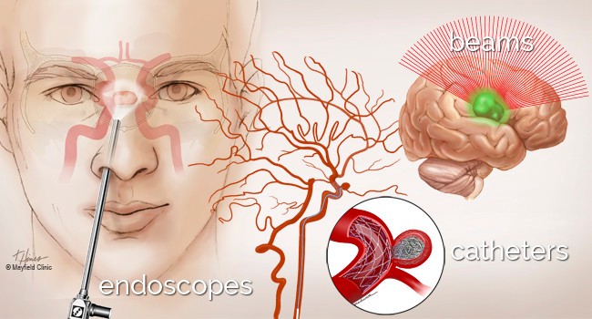 Innovative approaches allow less invasive access for brain surgery.