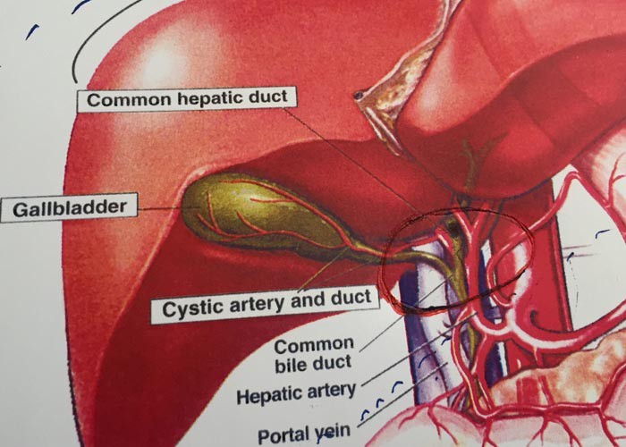 University of Cincinnati Cancer Institute transplant surgeons are offering a unique procedure to remove inoperable, cancerous tumors from the bile duct of the liver. The area circled on the diagram is what is removed along with the rest of the organ and is replaced with a new liver. 