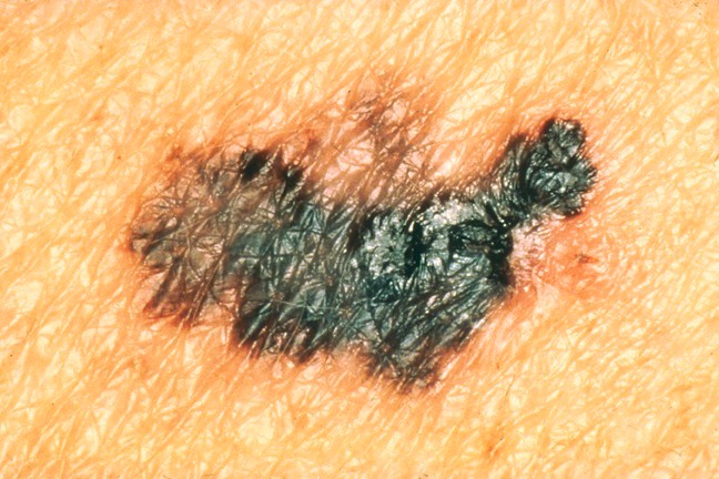 Example of melanoma with color differences.