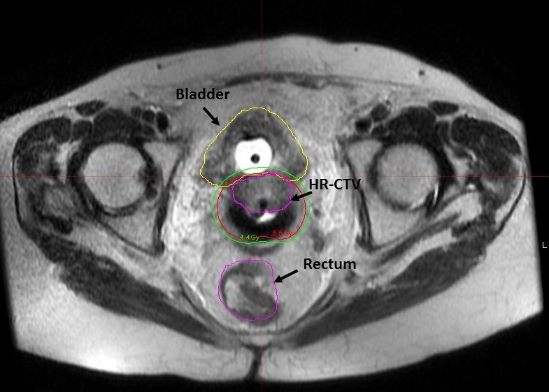 Â By coupling brachytherapy treatment with MRI, physicians gain anatomic information about the tumorÂ s volume in 3-D that is unattainable on CT scans alone,Â  says Jordan Kharofa, MD.