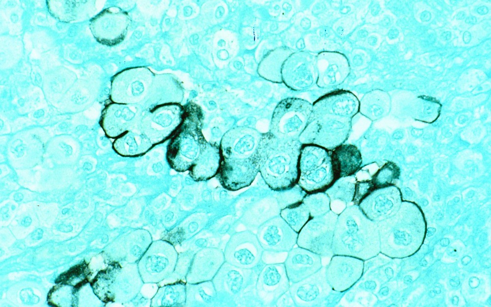 Pancreatic cancer cells, shown under a microscrope.