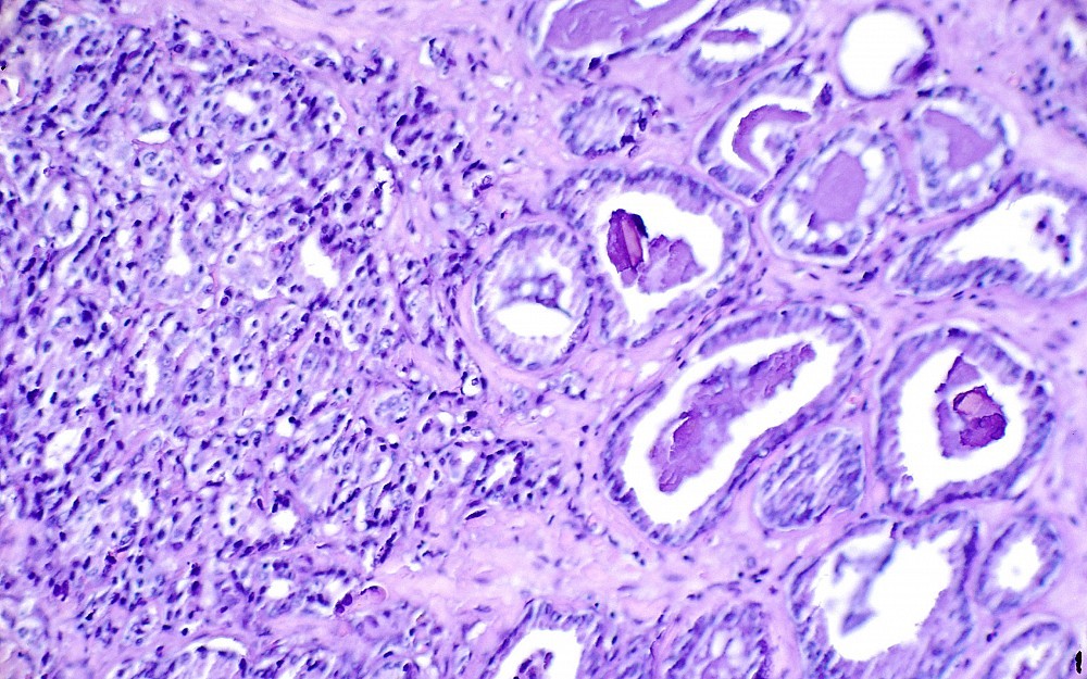 Prostate Cancer Cells