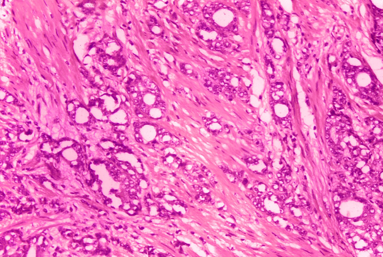 Prostate Cancer Cells 