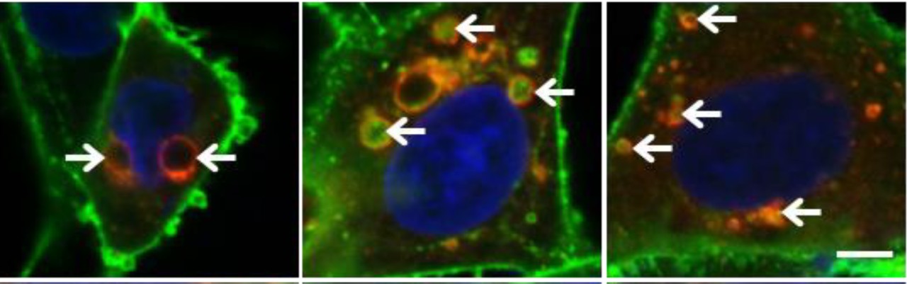 a microscopic image showing autophagy in tumor cells