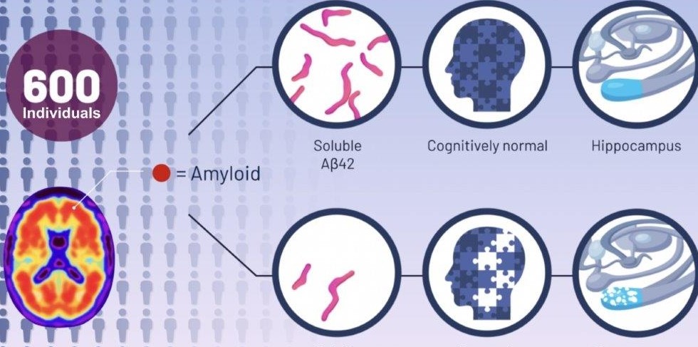 graphic of UC Alzheimer's study comparing brains with amyloids