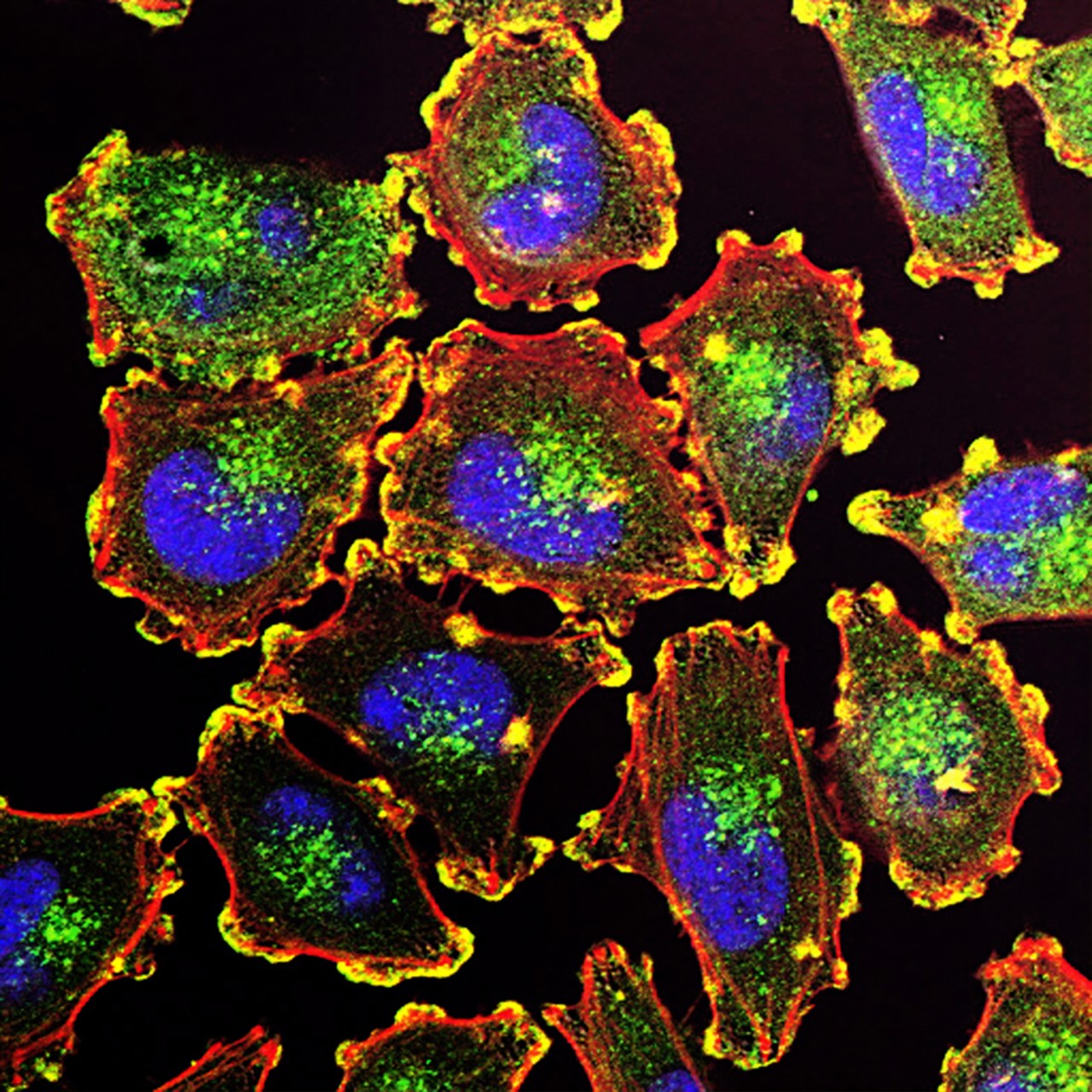 metastic melanoma cells