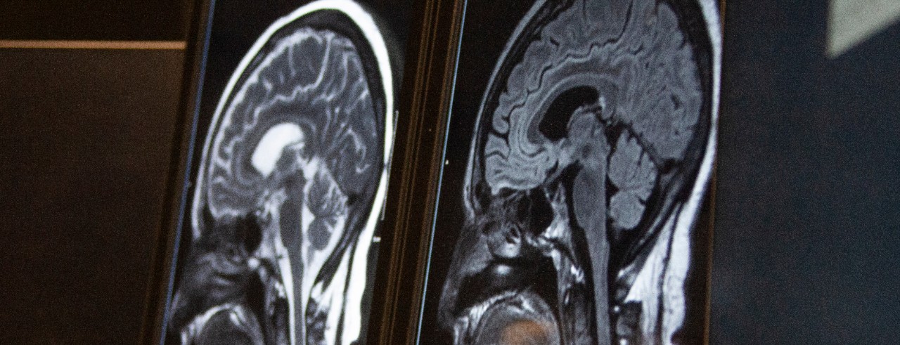 Two brain scans side by side on a computer monitor