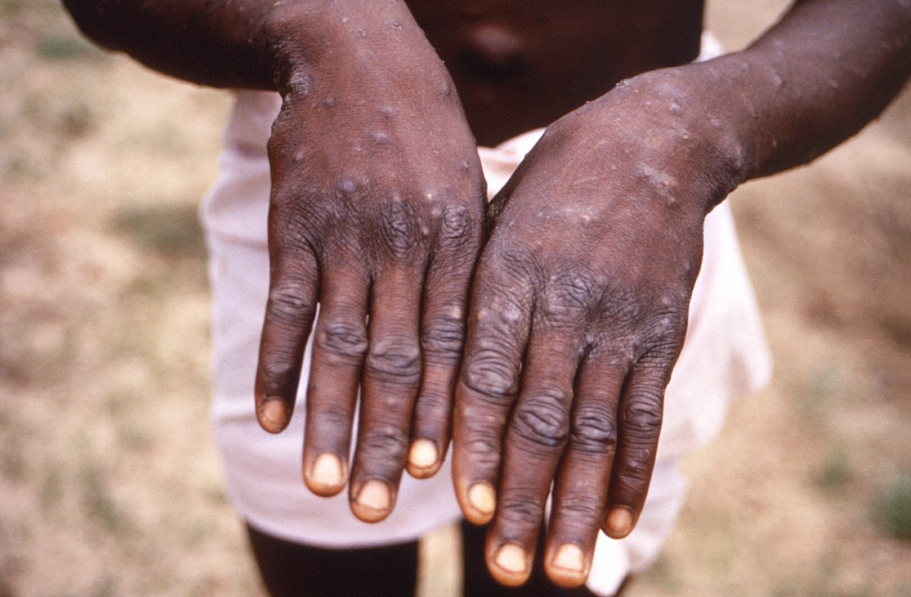 a person showing their hands with monkeypox