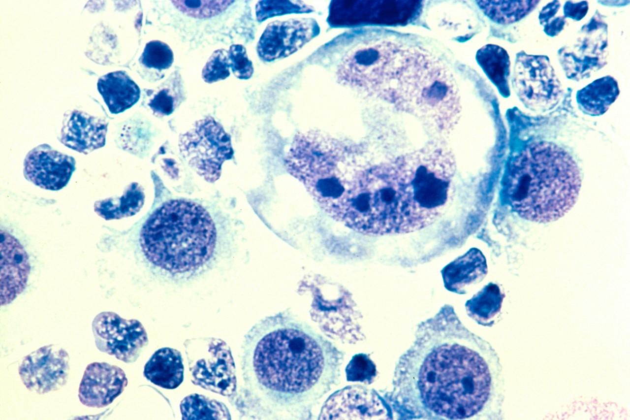 Human lymphoma tumor cells