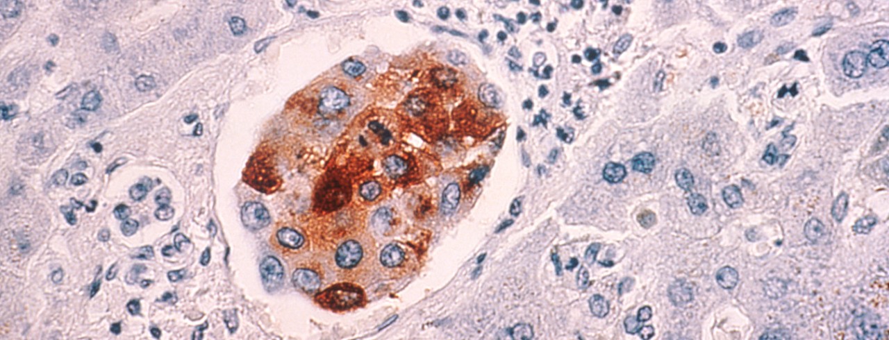 Breast cancer cells metastasized to the liver