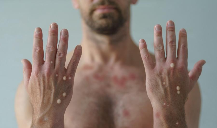 A photo of the hands of a person with monkeypox